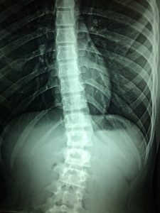 Image of an X-ray of a spine. The X-ray shows a damaged spine